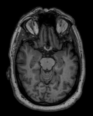 Axial slice of an MRI image of the brain